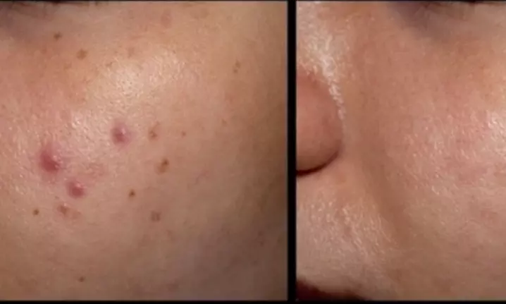 Up to 49% Off on Acne Treatment at Kingston SPALAX - Primary Image