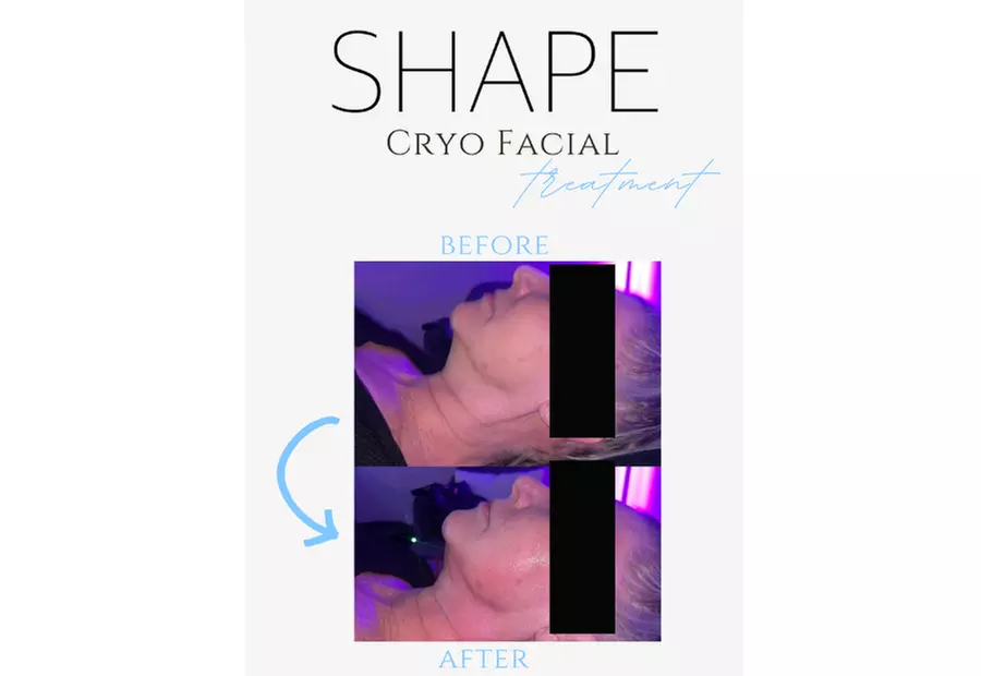 Up to 57% Off on Facelift - Non-Surgical at Shape - Second Medium
