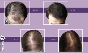 PRP Hair-Restoration Treatment