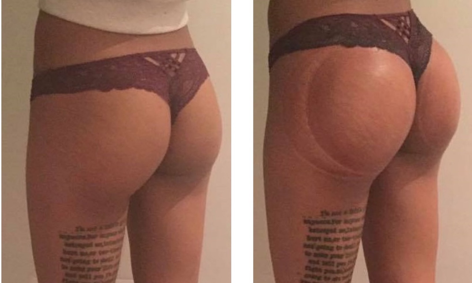 Non-surgical gluteoplasty with vacuum therapy and laser lipo