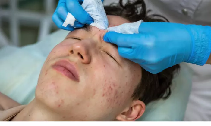 Up to 19% Off on Acne Treatment at Karina Skin Facials - Primary Image