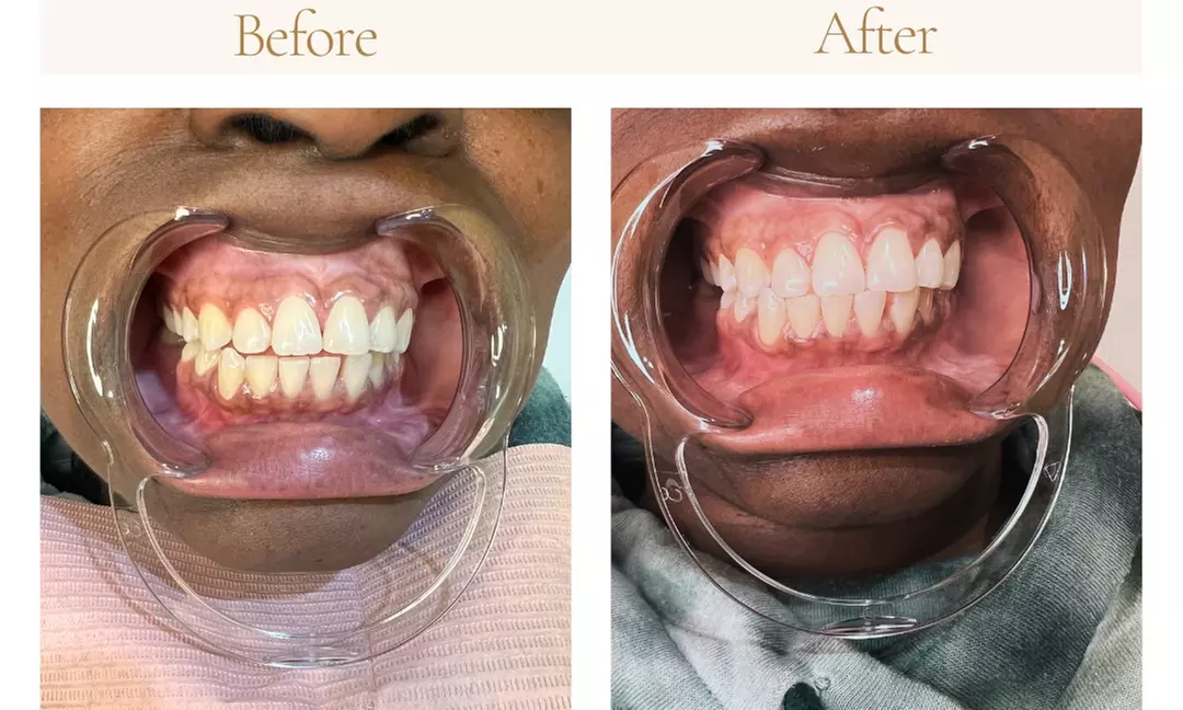 Brighten Your Smile with Advanced Teeth Whitening Sessions