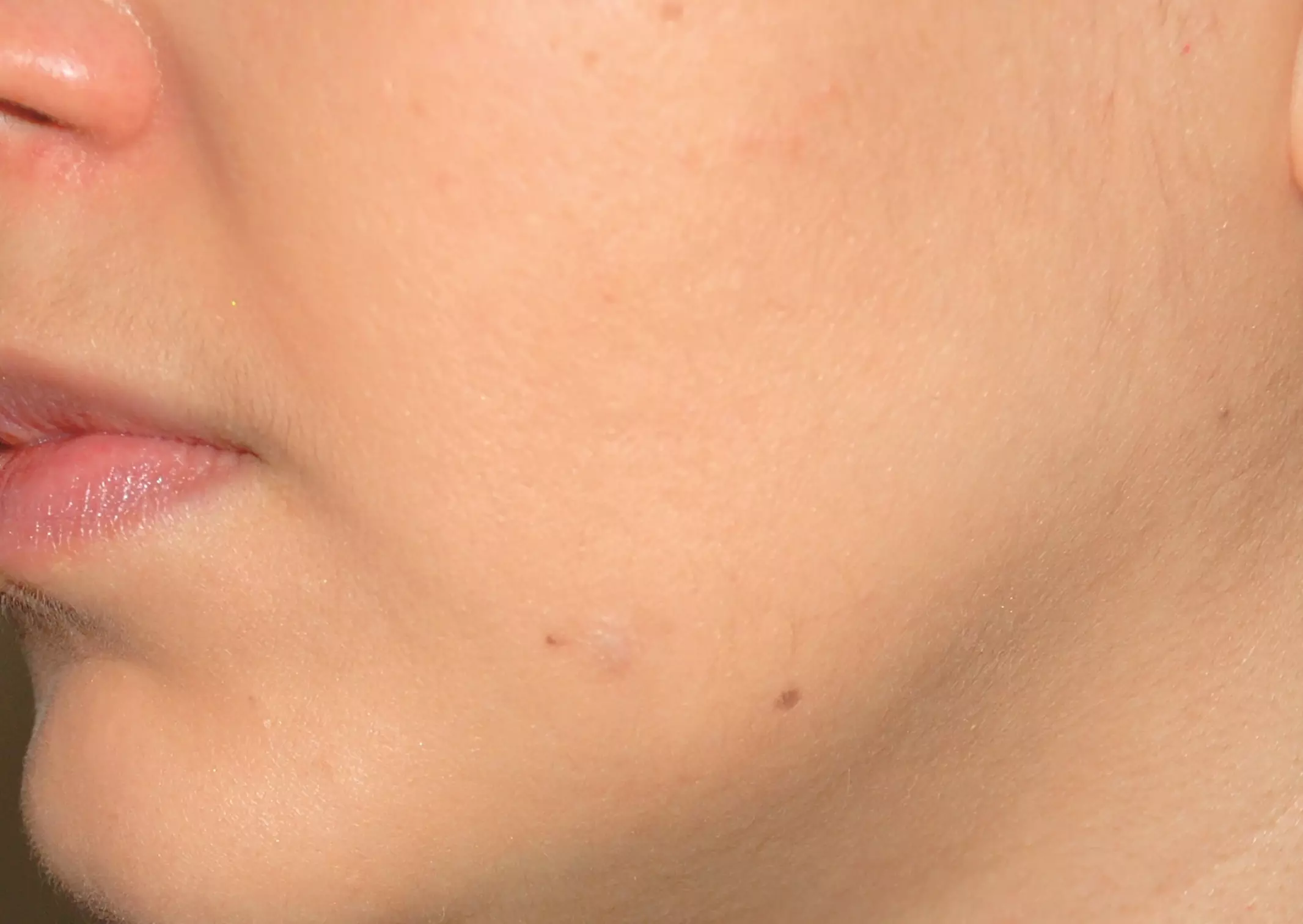 Safe and Easy Skin Lesion Removal for Face and Body