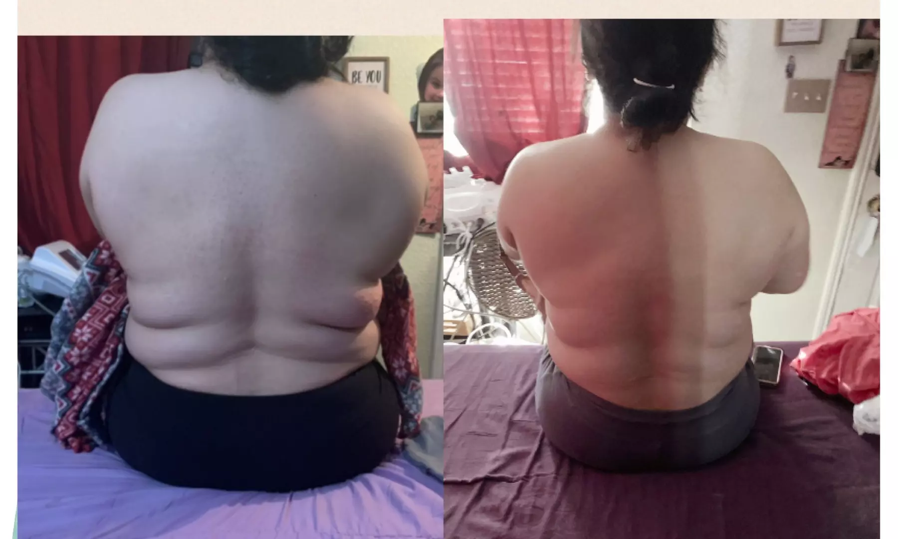 Ultrasonic Body Sculpting Sessions for a Sleeker You