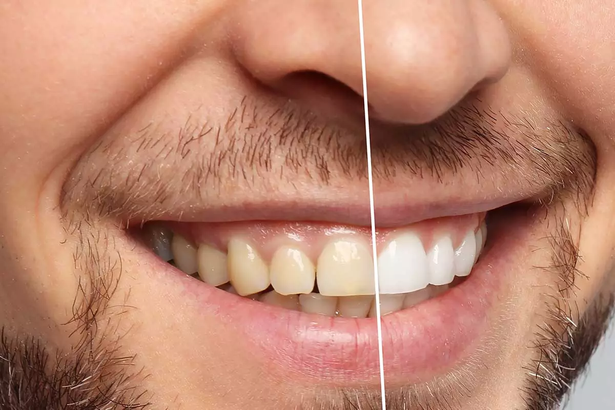 Sun Kissed Glo And Beauty Bar's Teeth Whitening: Three Tailored Options for a Brighter Smile up to 39% Off