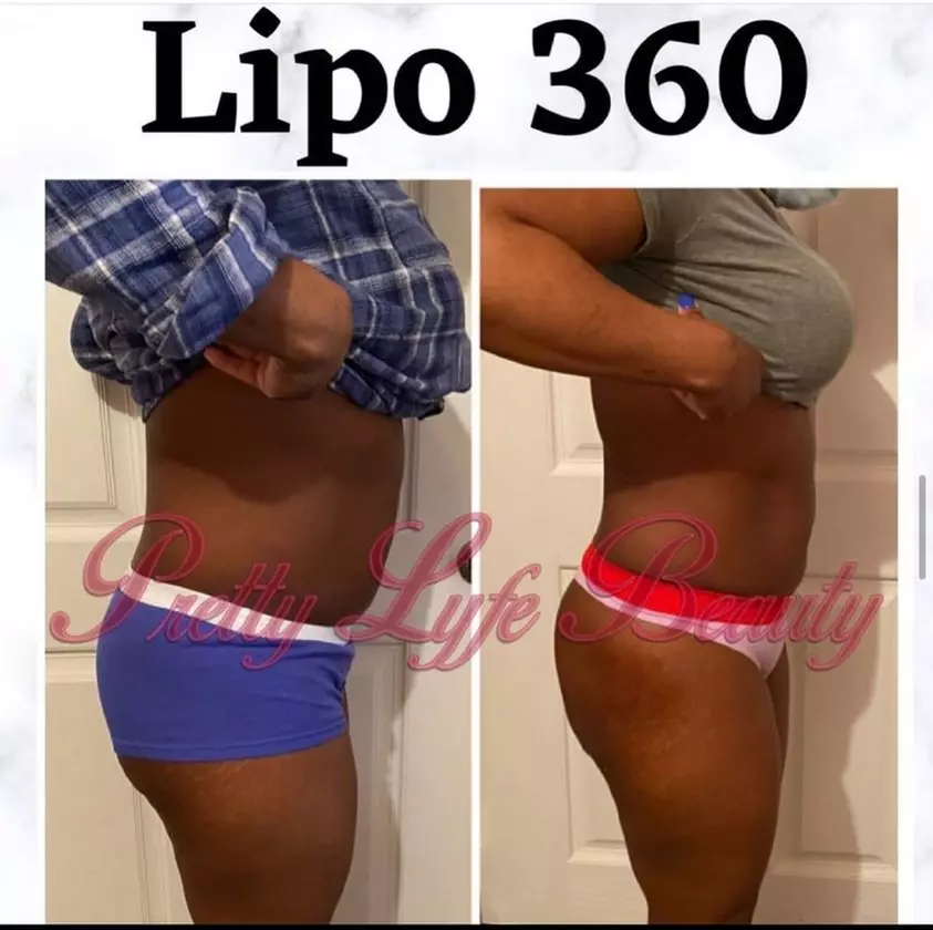 Up to 25% Off on Cavitation at Pretty Lyfe Esthetics