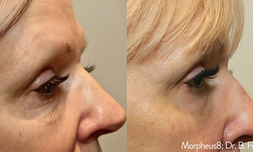 Image 5: Radiant Skin Awaits: Transform with Morpheus8 RF Technology!