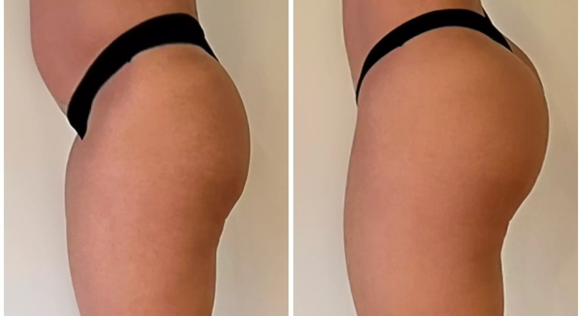 Experience a Brazilian Butt Lift with EMS Technology