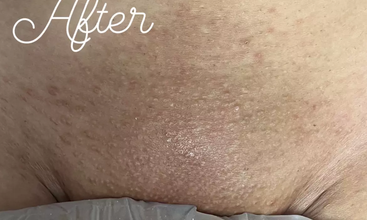 Up to 36% Off on Brazilian / Bikini Waxing at Thee Trusted Touch - Second Medium