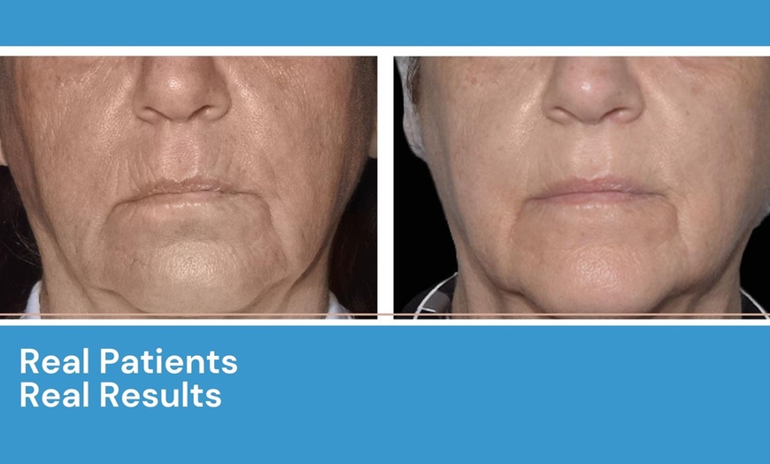 Image 8: Transform Your Skin with Exion Lips or Under Eyes Treatment