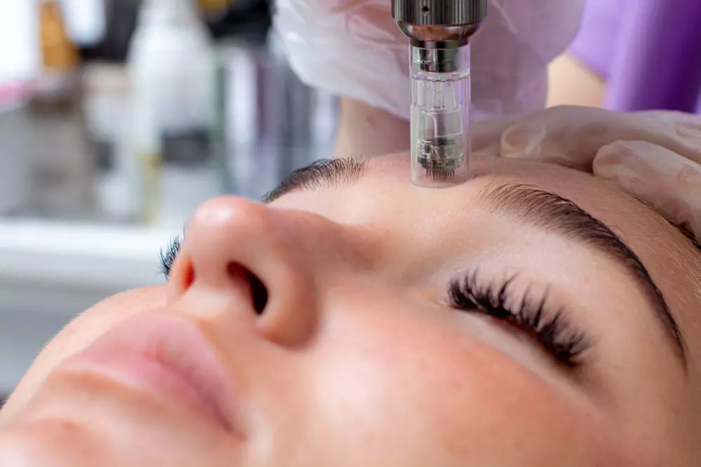 Up to 43% Off on Micro-Needling at Shine On Advanced Aesthetics - Primary Image