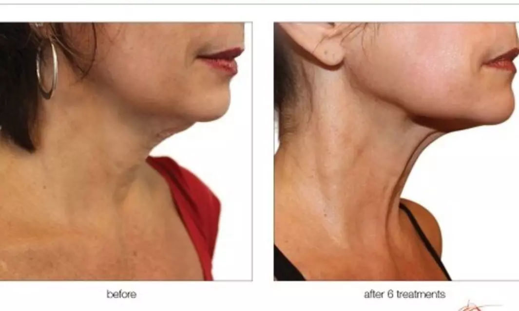 Up to 54% Off on Radio Frequency Skin Tightening at Beauty Factory Boutique Spa