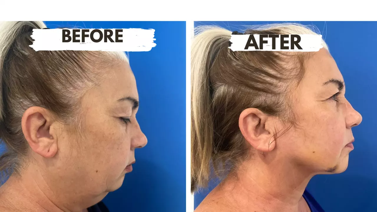 Double Chin lipo at Bioaesthetic by Dr. Castellanos - Primary Image