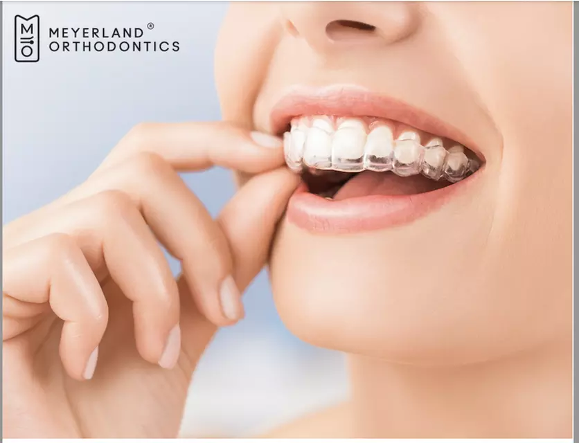 Up to 98% Off on Invisalign at Meyerland Orthodontics - Second Medium
