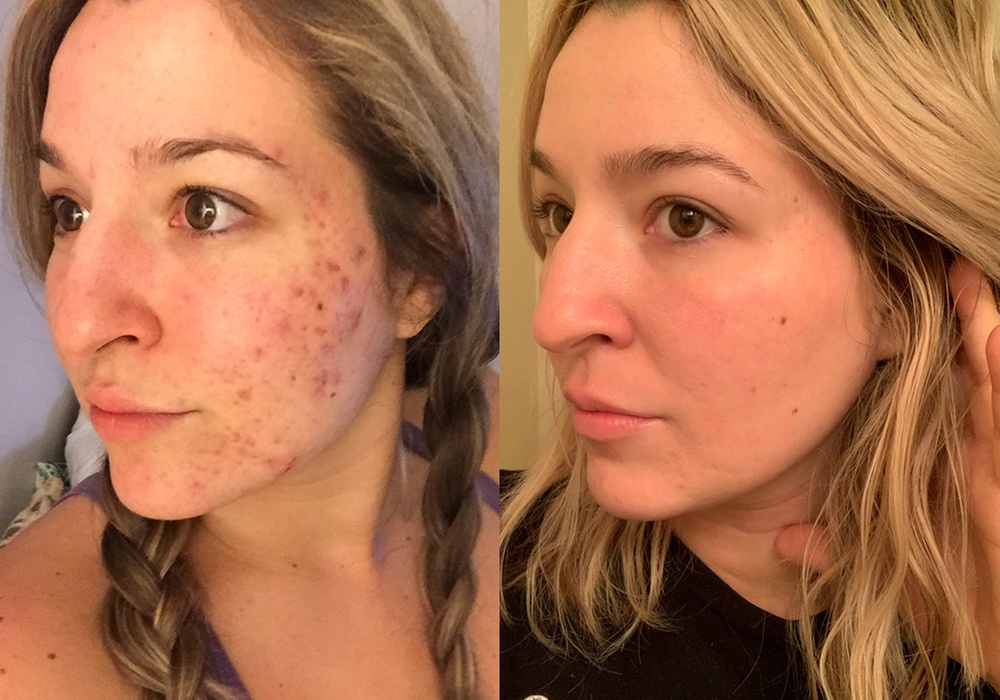 Revitalize Your Skin with a Choice of Laser Facial Treatments