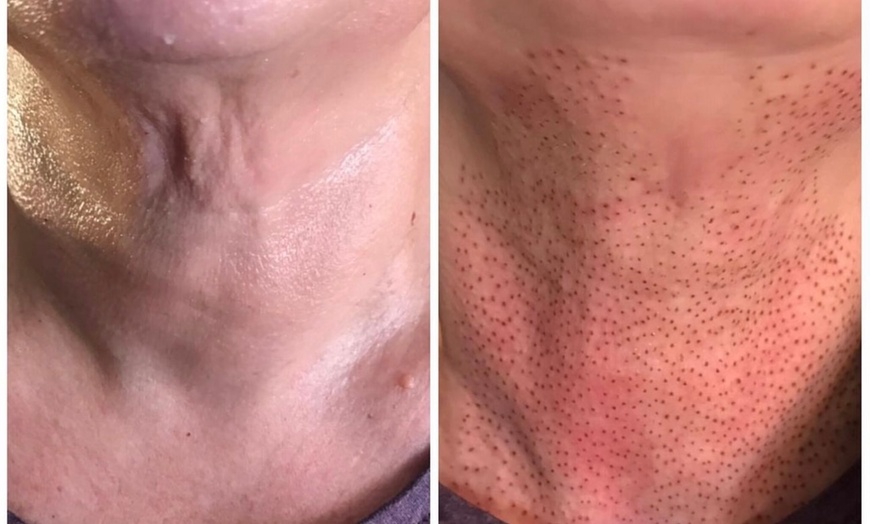 Image 2: Fibroblast Plasma Pen Lifts for Face and Neck