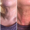 Image 2: Fibroblast Plasma Pen Lifts for Face and Neck
