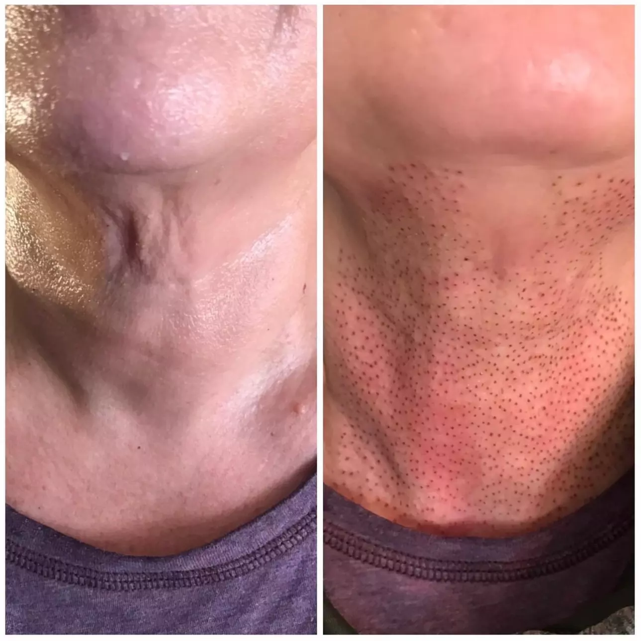 Fibroblast Plasma Pen Lifts for Face and Neck