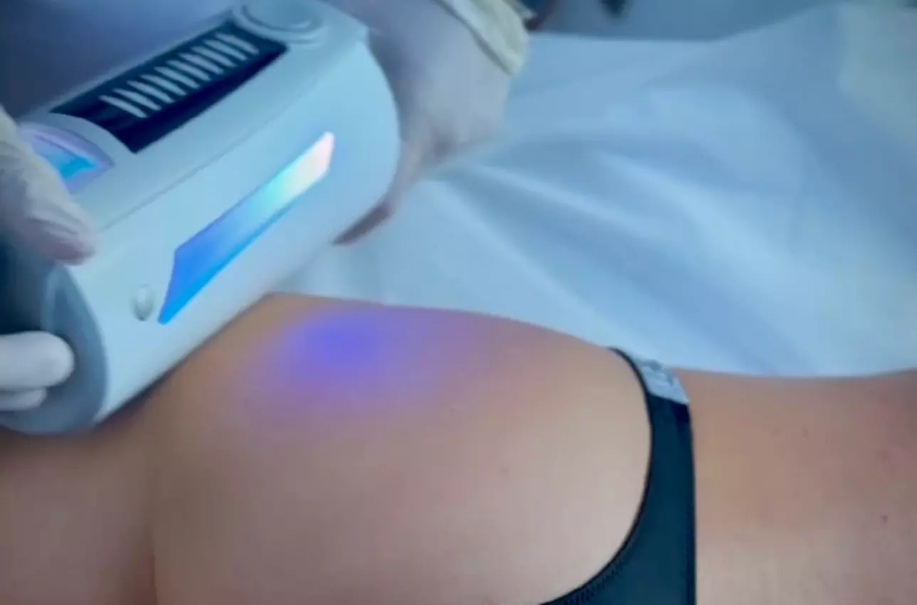 Up to 43% Off on Fat Reduction - Non-Branded at The Mespa - Primary Image