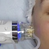 Image 1: Up to 55% Off on Micro-Needling at DivaVida LLC