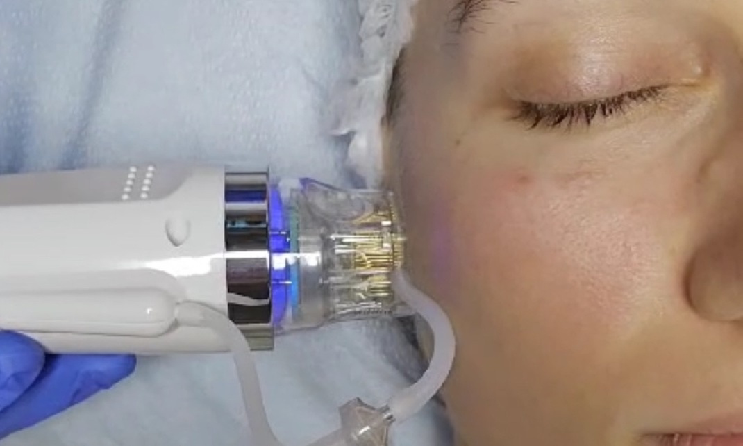 Up to 55% Off on Micro-Needling at DivaVida LLC - Primary Image