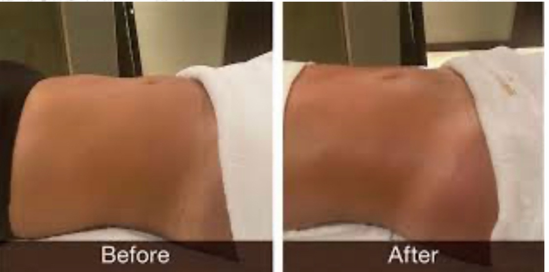 At Beauty and Bodied Aesthetics, enjoy a range of lymphatic drainage massages with sessions up to 62% off. - Primary Image