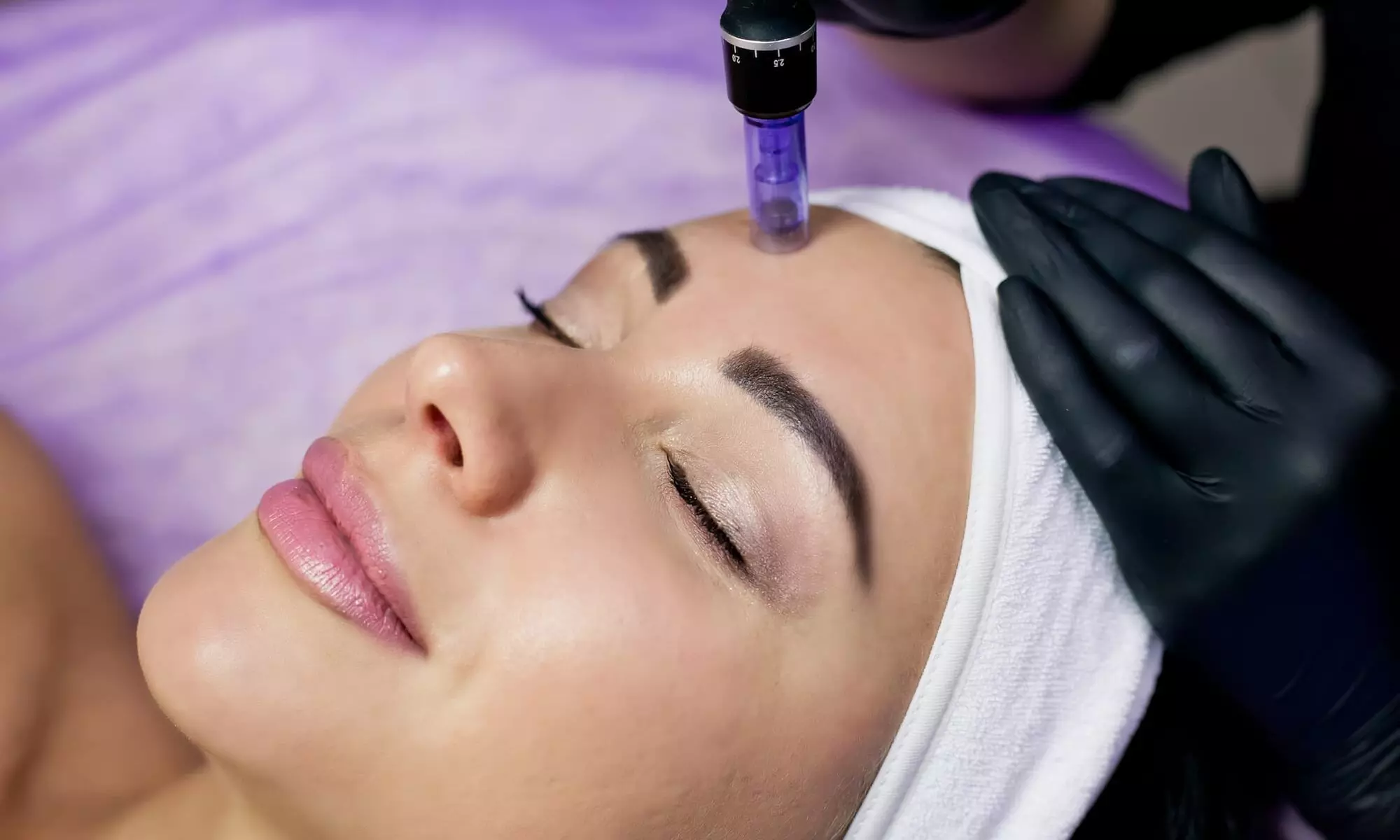 Unlock radiant skin at Allure Aesthetics RN with 1 or 2 micro-needling sessions, achieving up to 44% off - Primary Image
