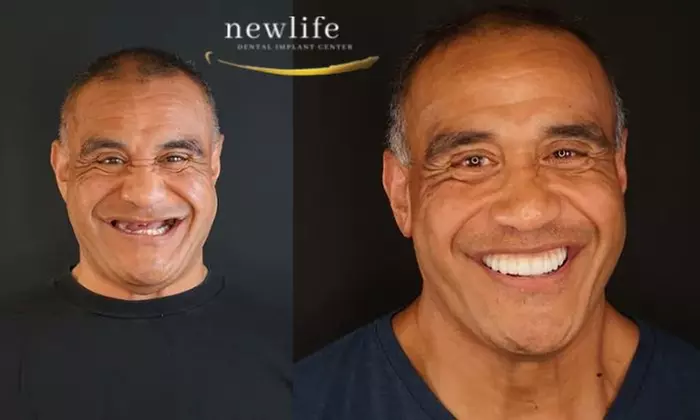 Up to 89% Off on Dental Implant / Corona / Veneer at New Life Dental Implant Center - Primary Image