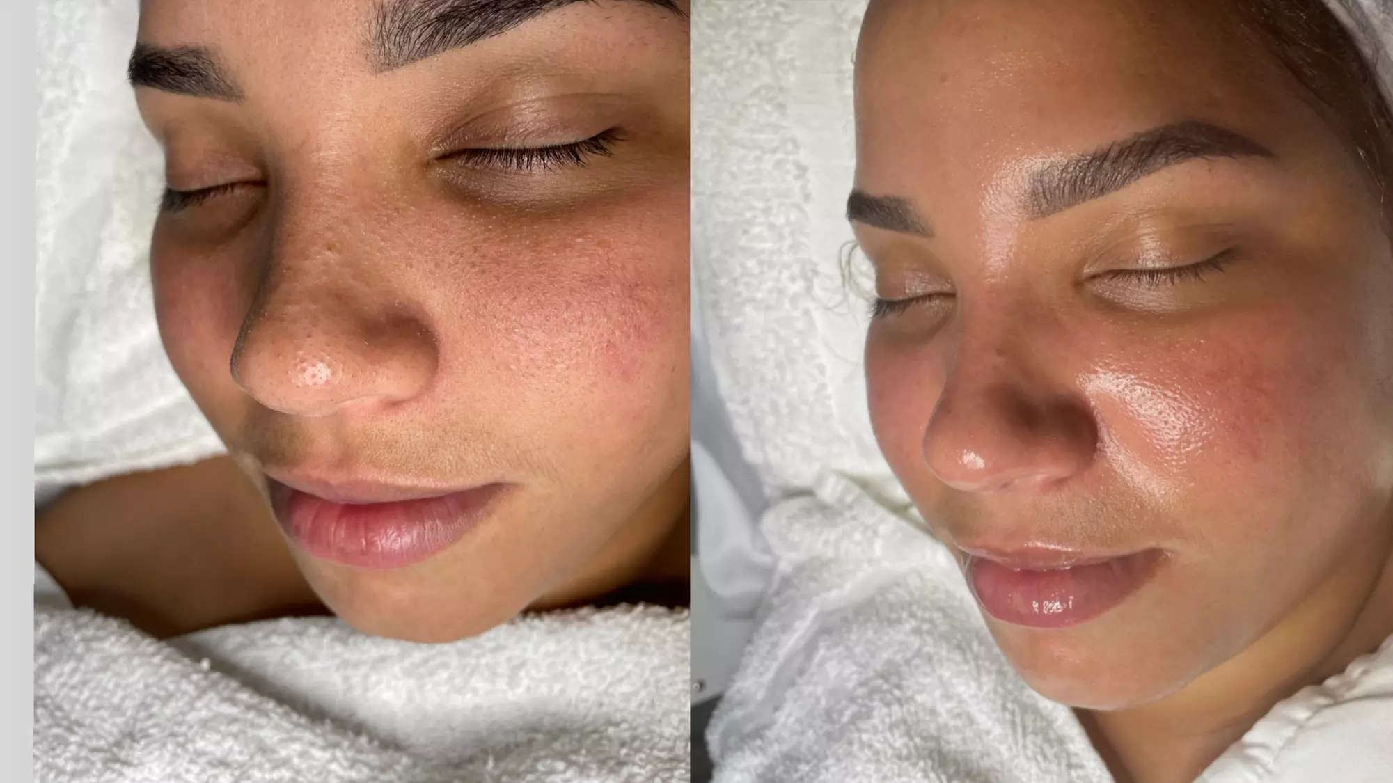 Enhance your skin's radiance with Revive Esthetic's Microdermabrasion Treatment, up to 50% off - Primary Image