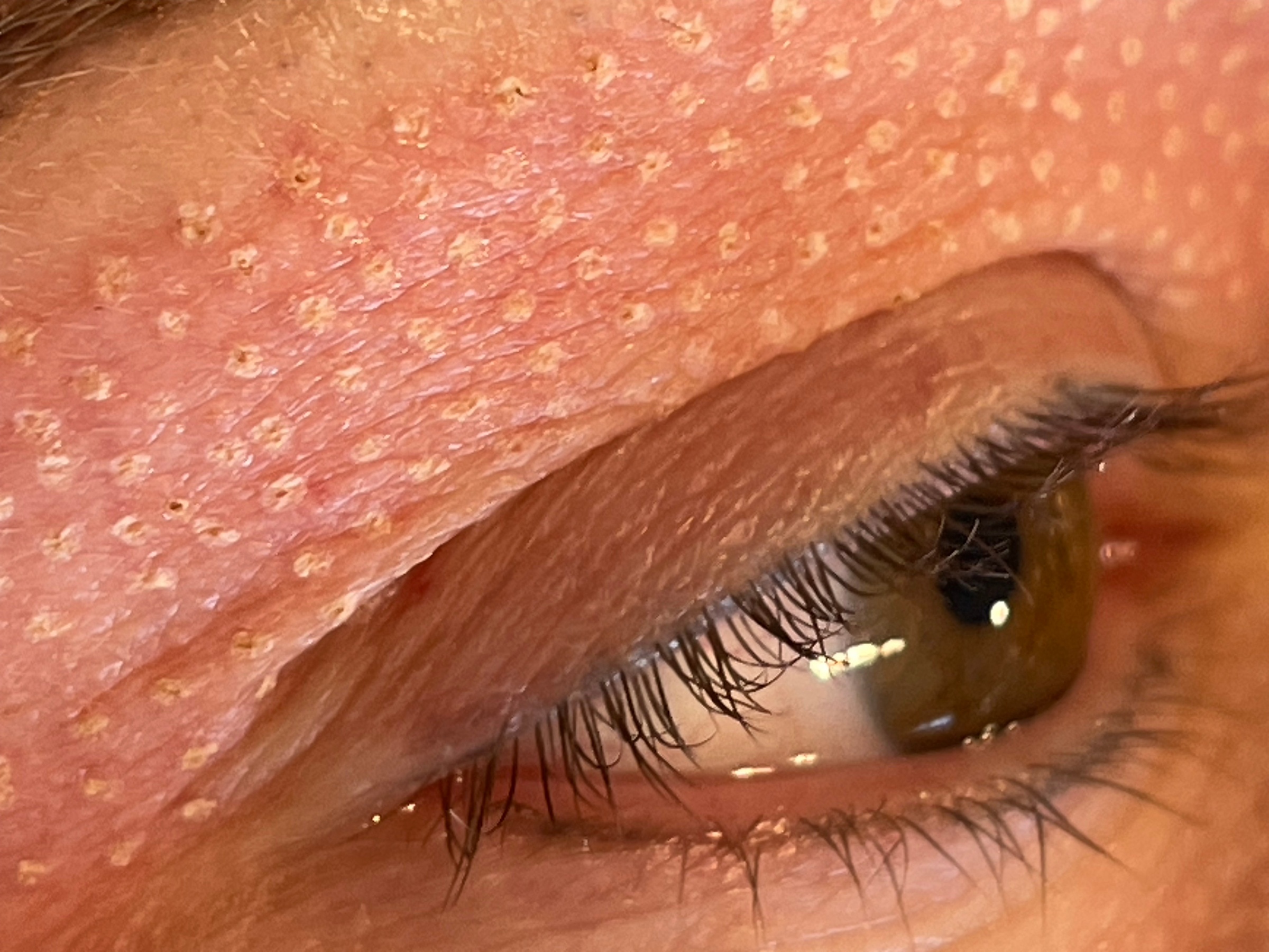 Plasma Fibroblast Eye, Jowl & Neck Lift Treatment