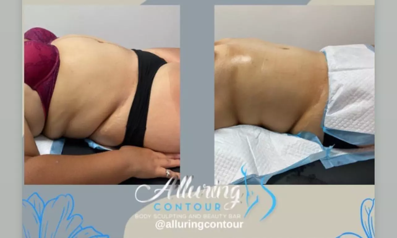 Alluring Contour offers diverse body contouring choices like Alluring Snatched and The Refresher, up to 46% off - Primary Image