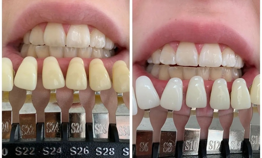 Image 2: Laser Teeth Whitening for a Brighter Smile