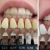 Image 3: Laser Teeth Whitening for a Brighter Smile