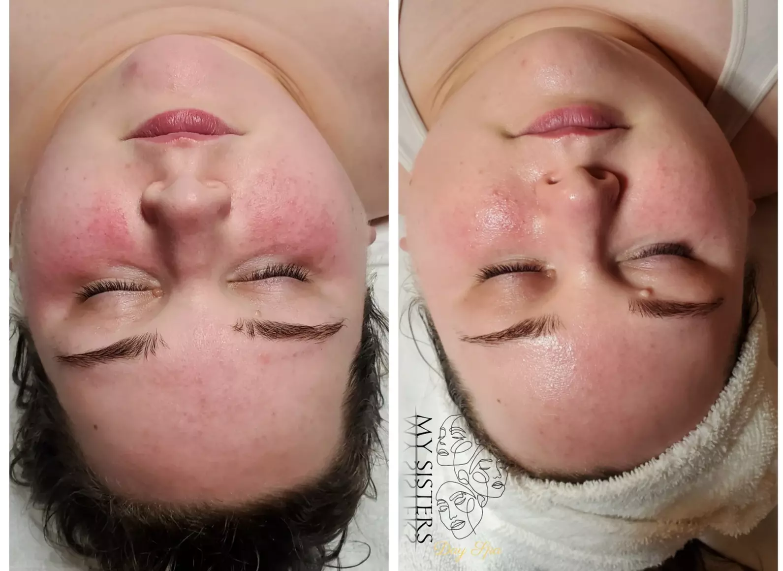 Experience The Skincare Experience's microdermabrasion treatment with up to 50% off for radiant skin - Primary Image