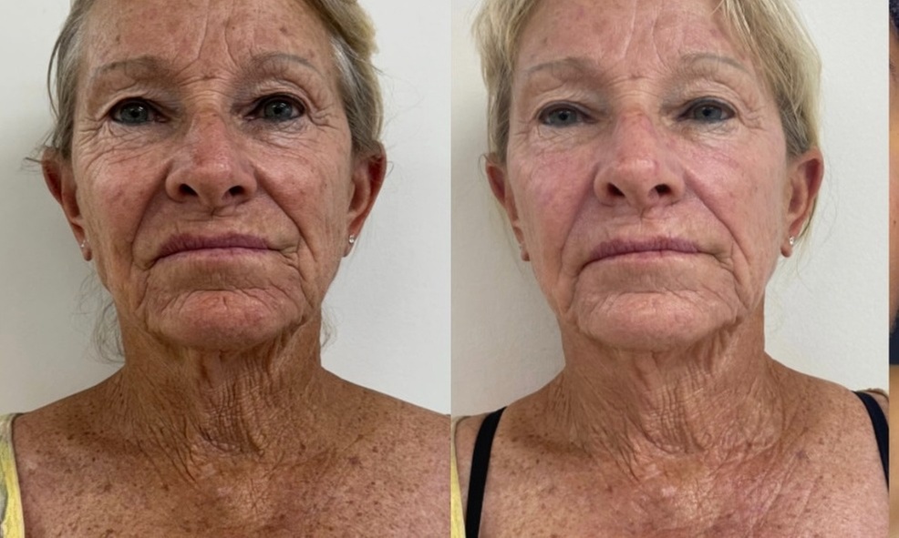 Up to 30% Off on Microdermabrasion at L'orange Aesthetics - Second Medium