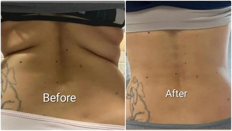 Up to 50% Off on Fat / Cellulite Reduction - Non-Branded at Noire Aesthetics