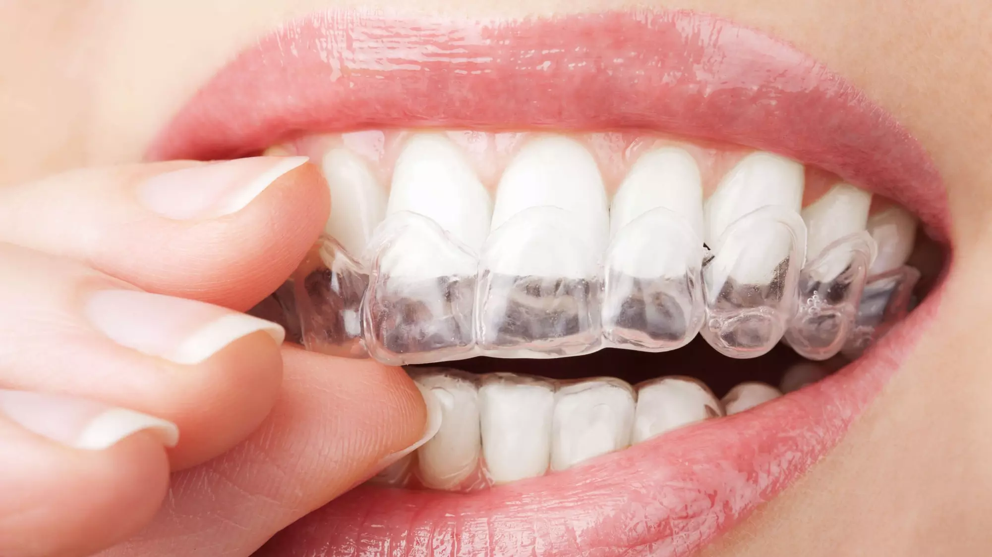 Up to 80% Off on Invisalign at Dental Art on Harbord - Primary Image