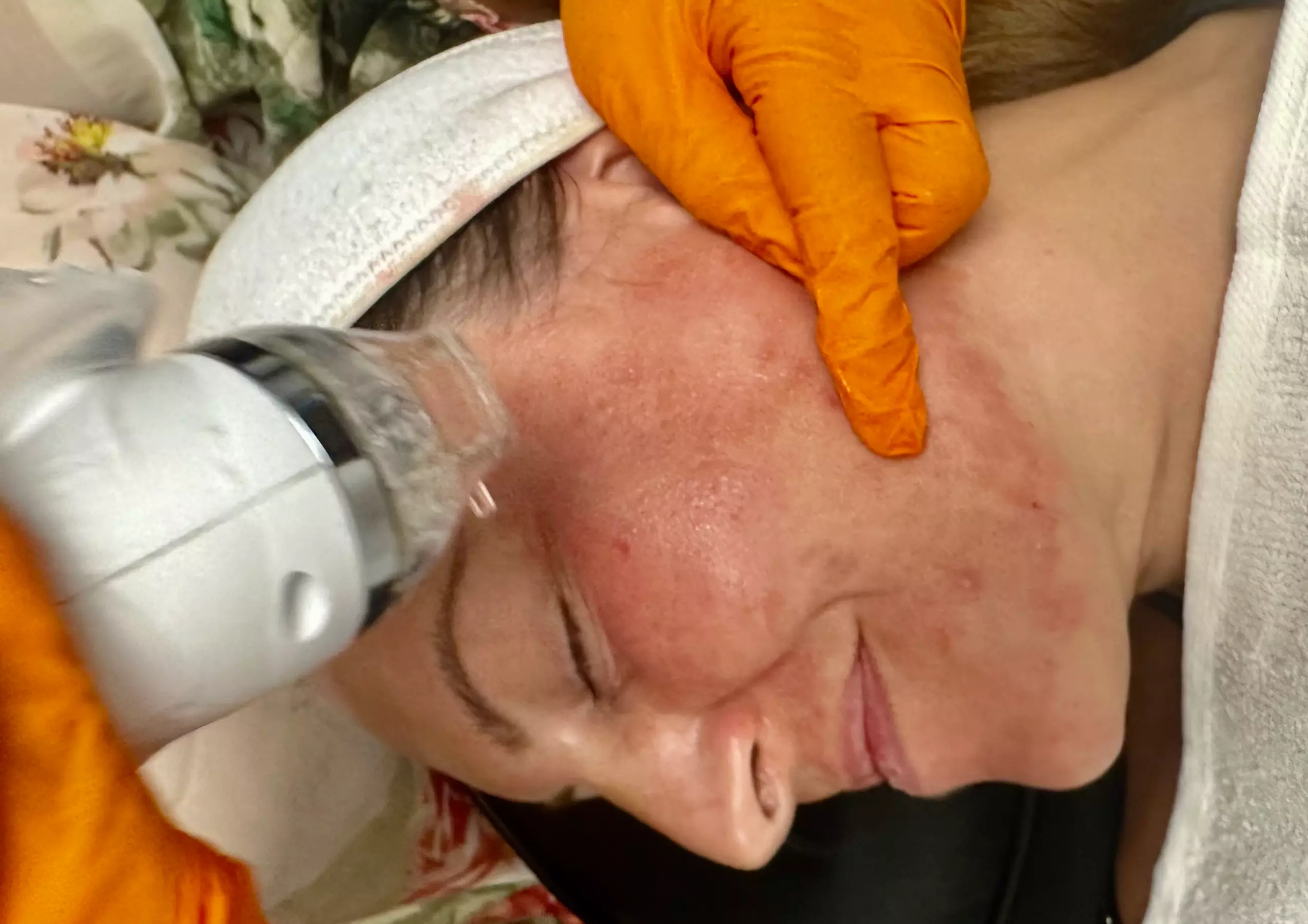 Unveil radiant skin with three Microneedling treatments and PRP face