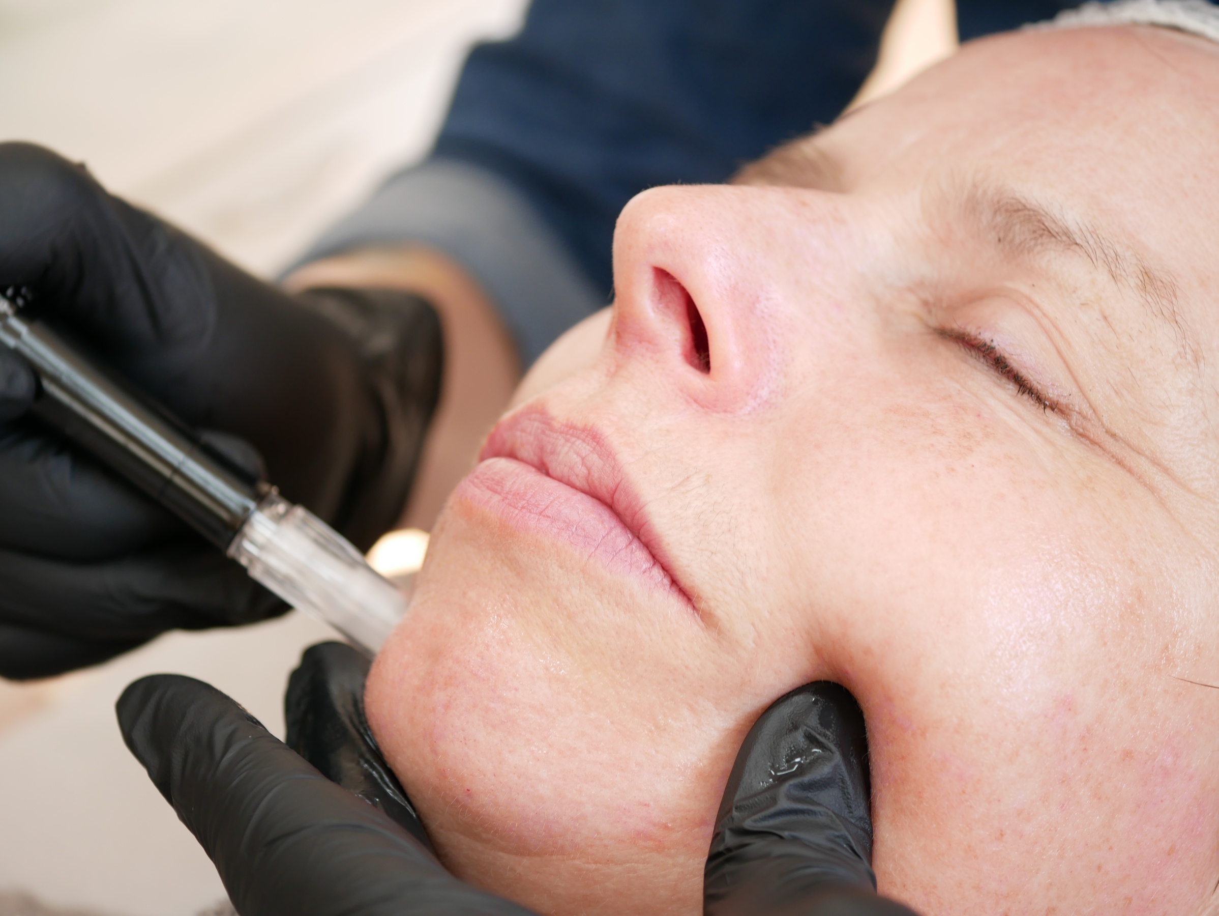 Bis zu 40% Rabatt auf Micro-Needling bei Deelashes