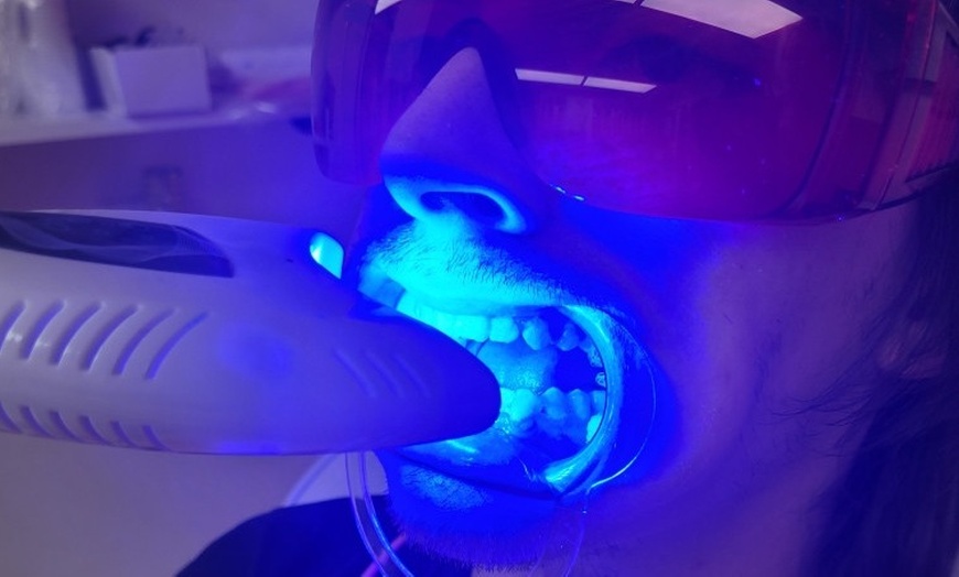 Image 1: Up to 49% Off on Teeth Whitening - In-Office - Non-Branded at Ur Bryte Smile Teeth Whitening