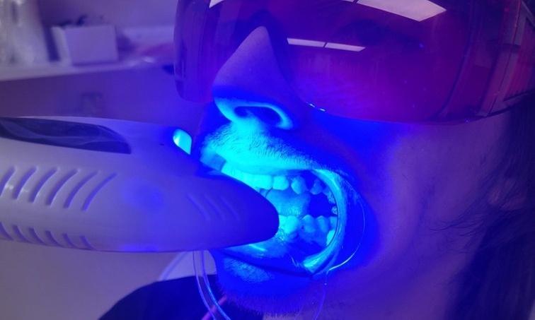 Up to 54% Off on Teeth Whitening - In-Office - Non-Branded at Ur Bryte Smile Teeth Whitening