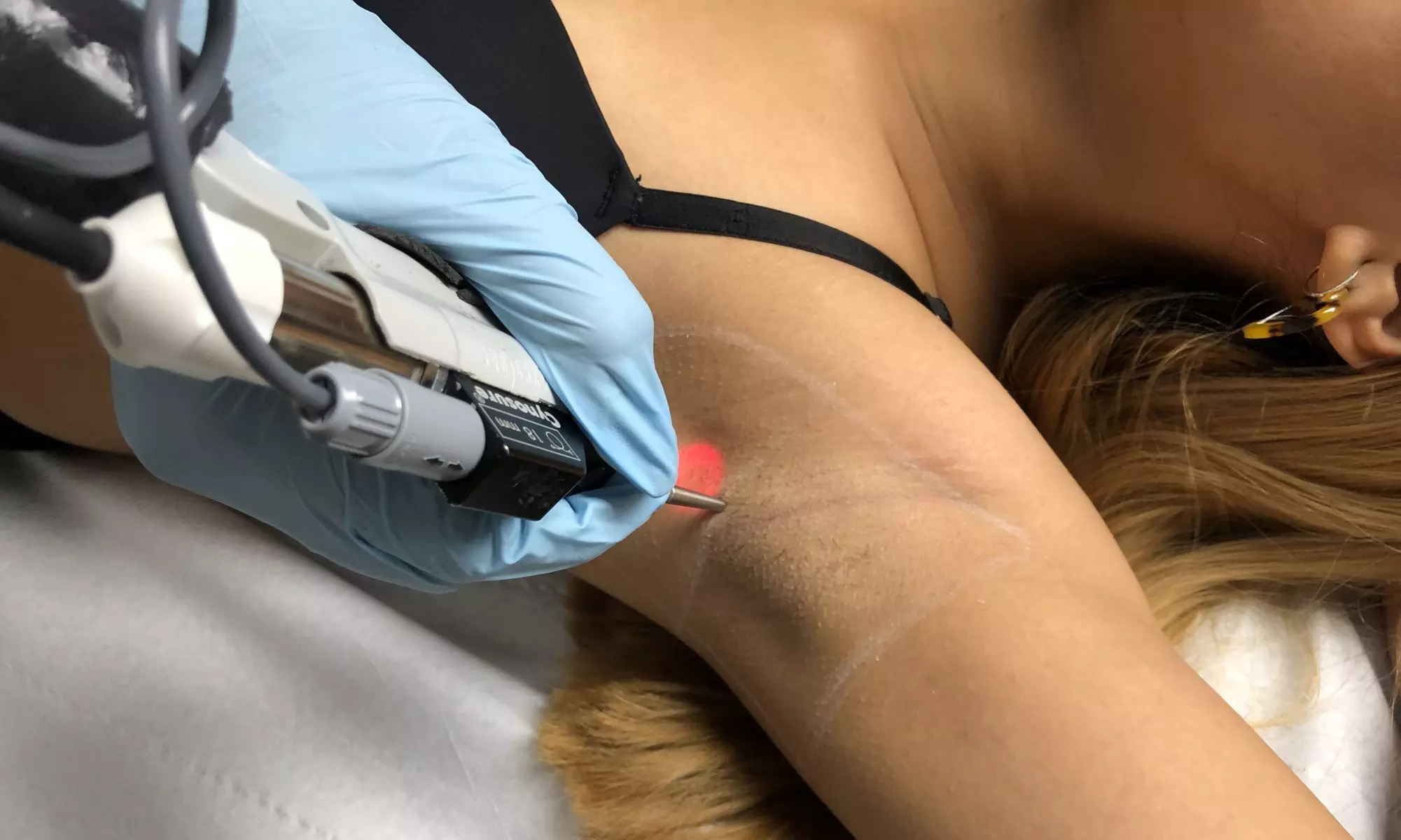 Six Laser Hair Removal Sessions for S, M, L or Half Body Areas at Z Glow Spa - Up to 75% Off - Primary Image