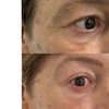 Image 1: One Fibroblast Plasma Session on Choice of Treatment Areas
