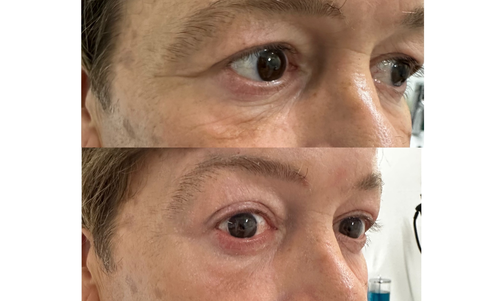 One Fibroblast Plasma Session on One Small, Medium, Large, Extra Large Area or for Hands ( Up to 56% Off ) - Primary Image