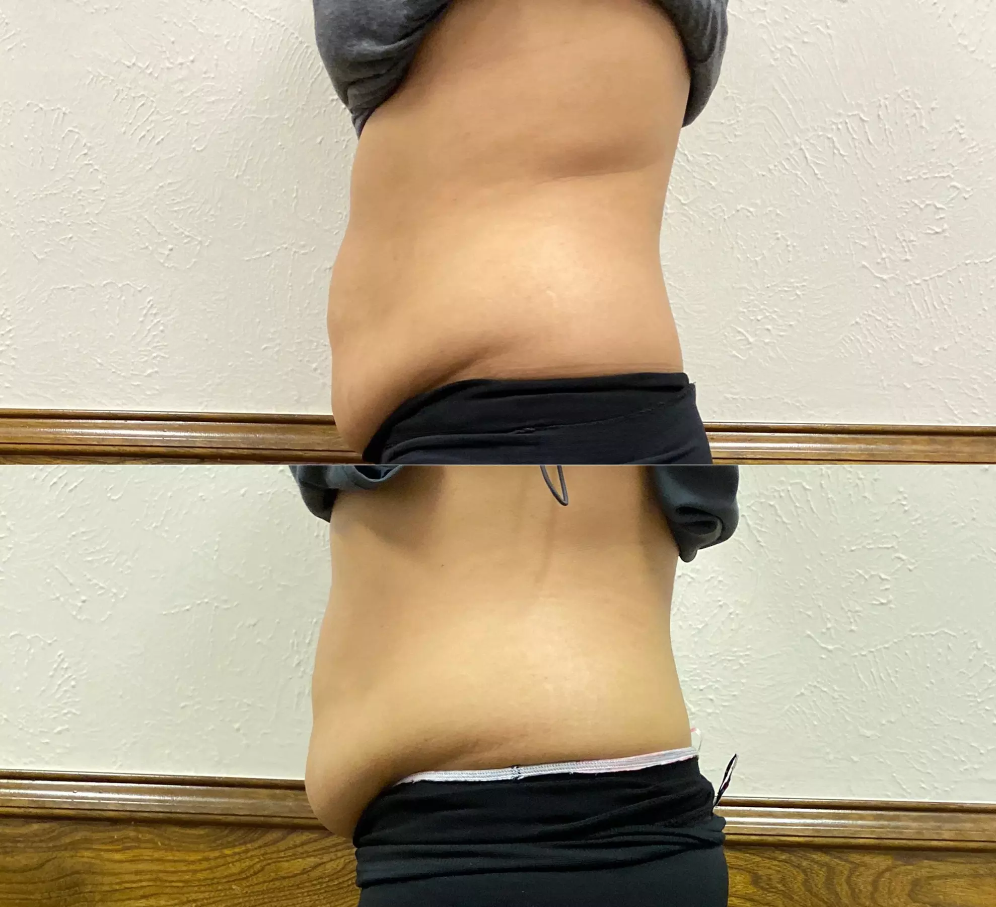 Explore Multiple Stomach Lipo Cavitation Sessions Options