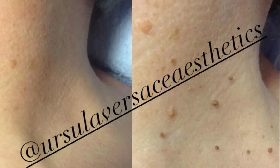 Experience Ursula Versace Aesthetics' beauty package with up to 30% off for 1 to 4 skin tags removal - Primary Image