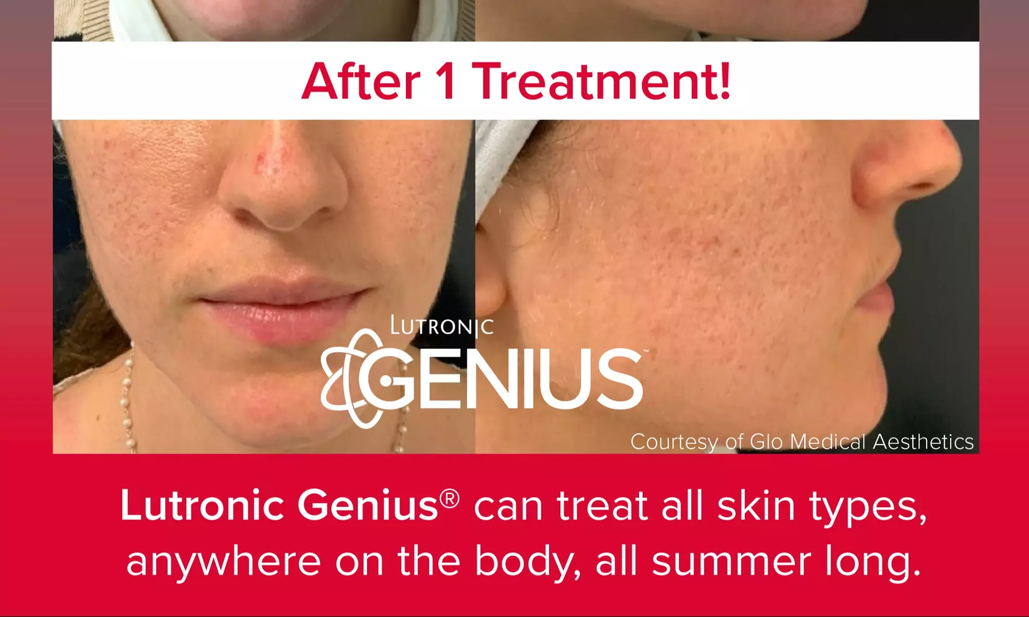 Glow Up with One Genius Radiofrequency Micro-Needling Treatment with Laser Facial Add-on (Up to 44% Off) - Primary Image