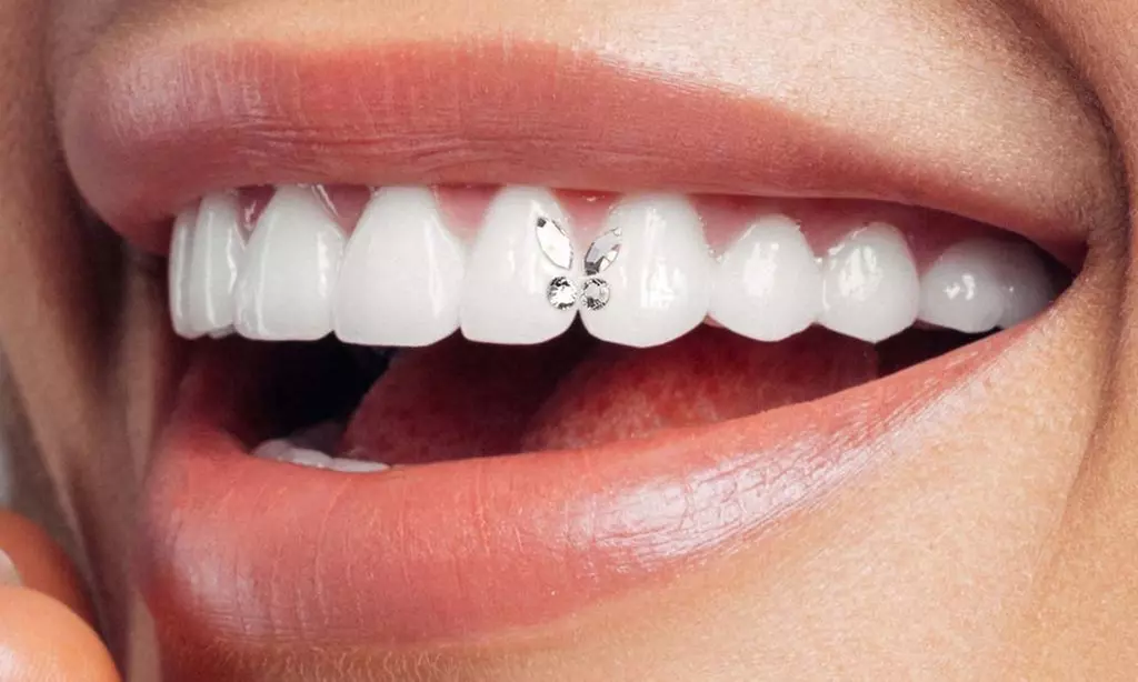Up to 56% Off on Teeth Whitening at Vivid Smile Lab - Primary Image