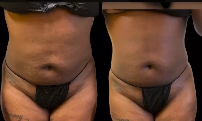 Experience the luxury of Lashay's Faces with two radio frequency body sculpting sessions at home, enjoying up to 50% off - Primary Image