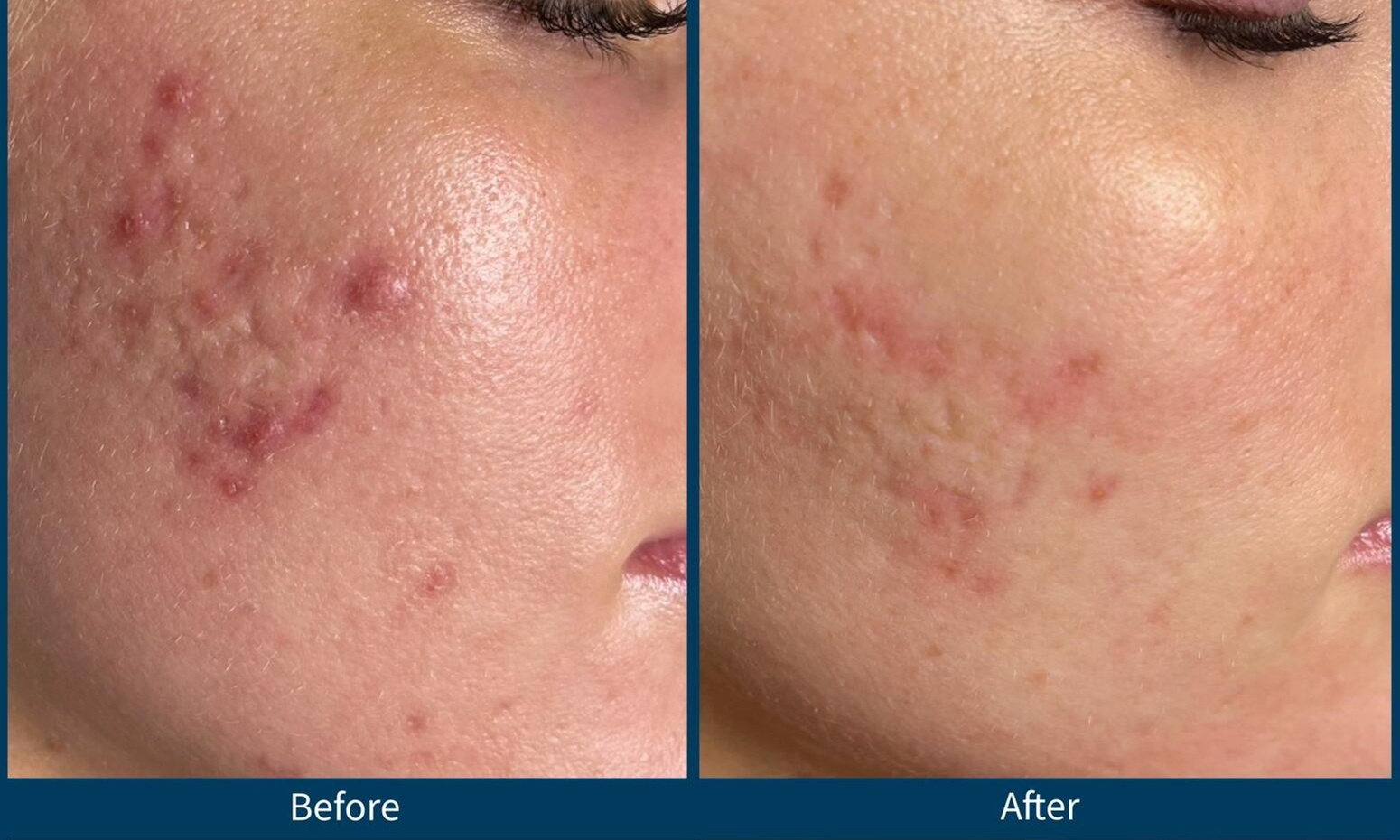 Up to 30% Off on Microneedling at Northshore Health and Beauty